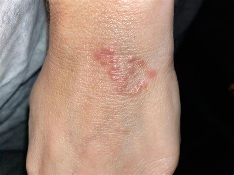 rash from wearing watch.